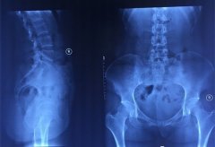 美式整脊对X光片拍摄要求