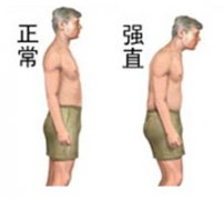 强直性脊柱炎的治疗方法_刘冠辰ART整体康复